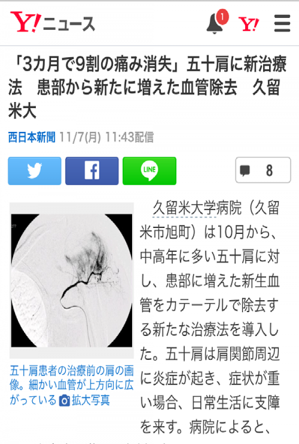 西日本新聞に五十肩へのカテーテル治療が掲載されました！
